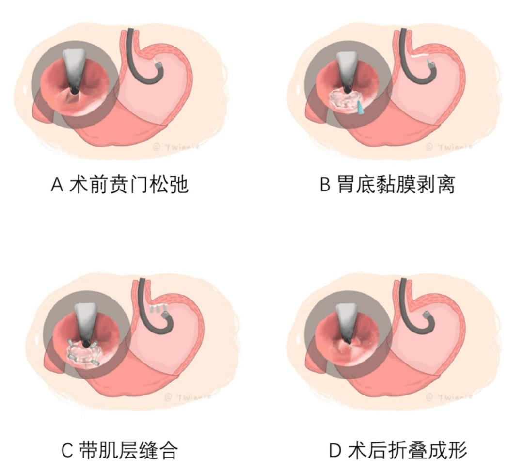 据消化内镜中心宛新建教授介绍,内镜下胃底黏膜切除后带肌层缝扎折叠
