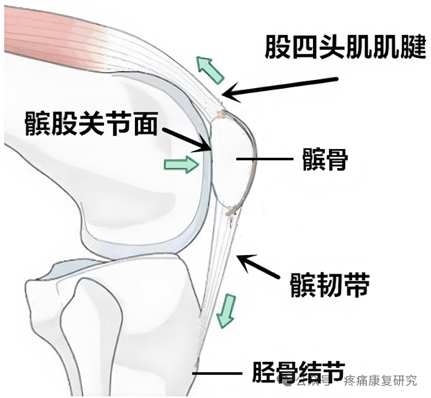 原因:髌骨软骨磨损或肌肉失衡致髌骨移位