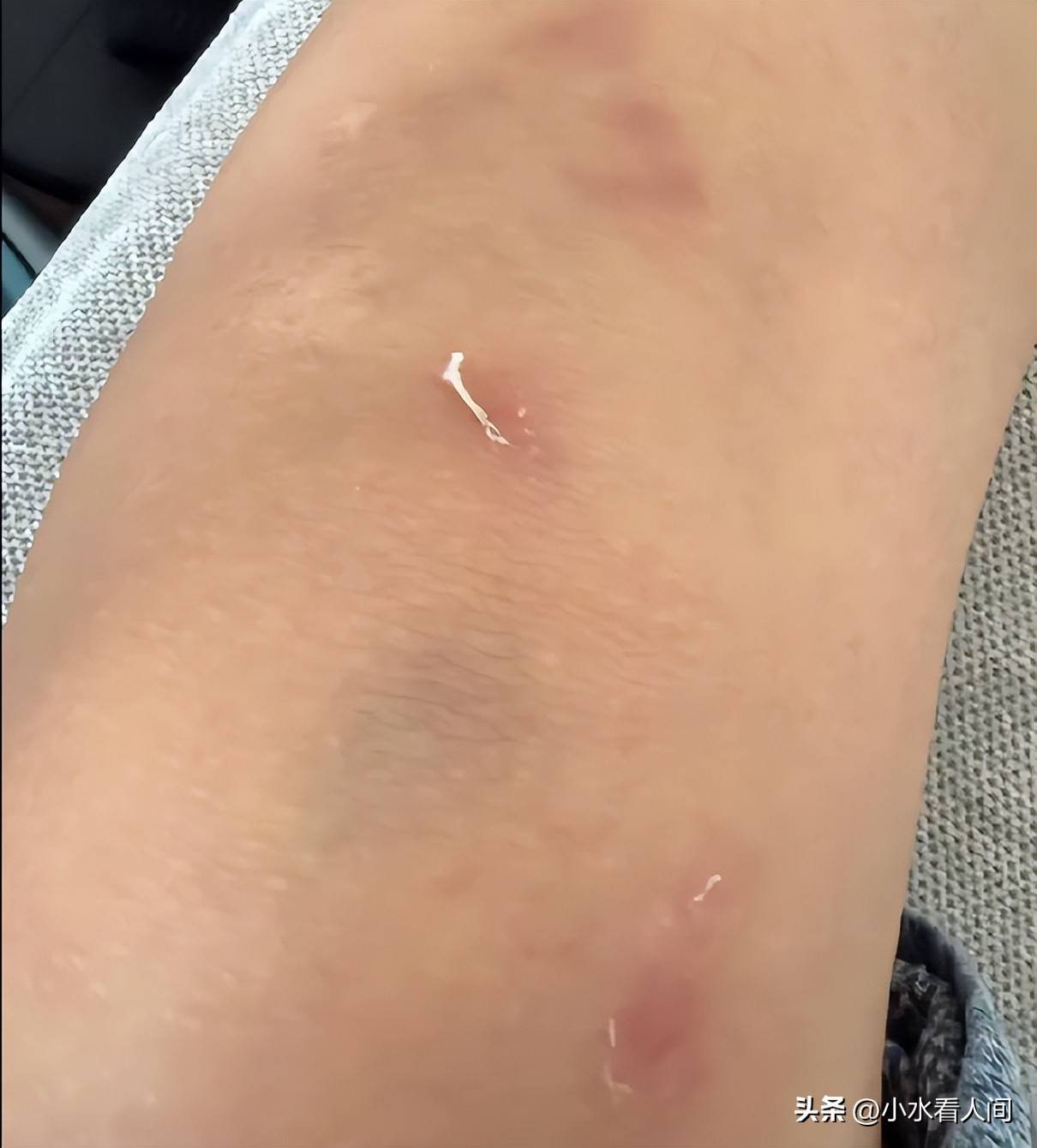 能把一双腿踩出这么多片淤青,可见打人者真的下狠手了