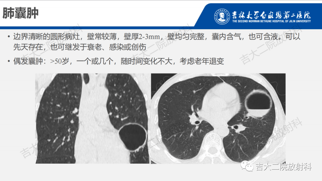 肺含气囊性病变的影像表现