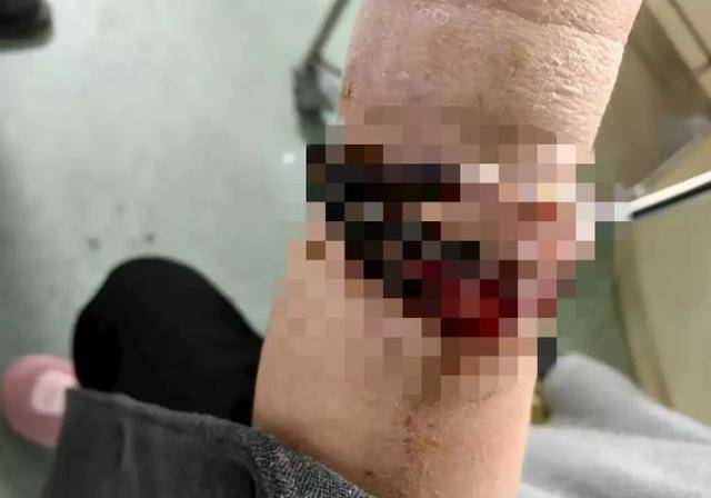 女子手镯10年没摘竟“长”进肉里！医生：再晚点就保不住了