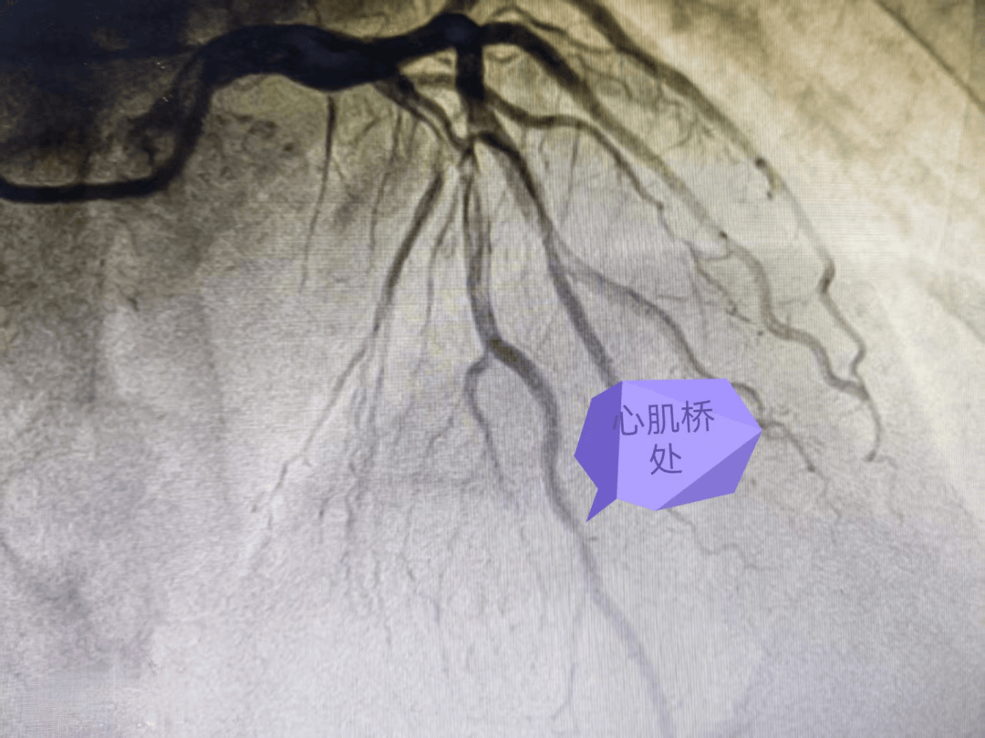 心肌桥特点是:心脏收缩时心肌内的冠状动脉受压