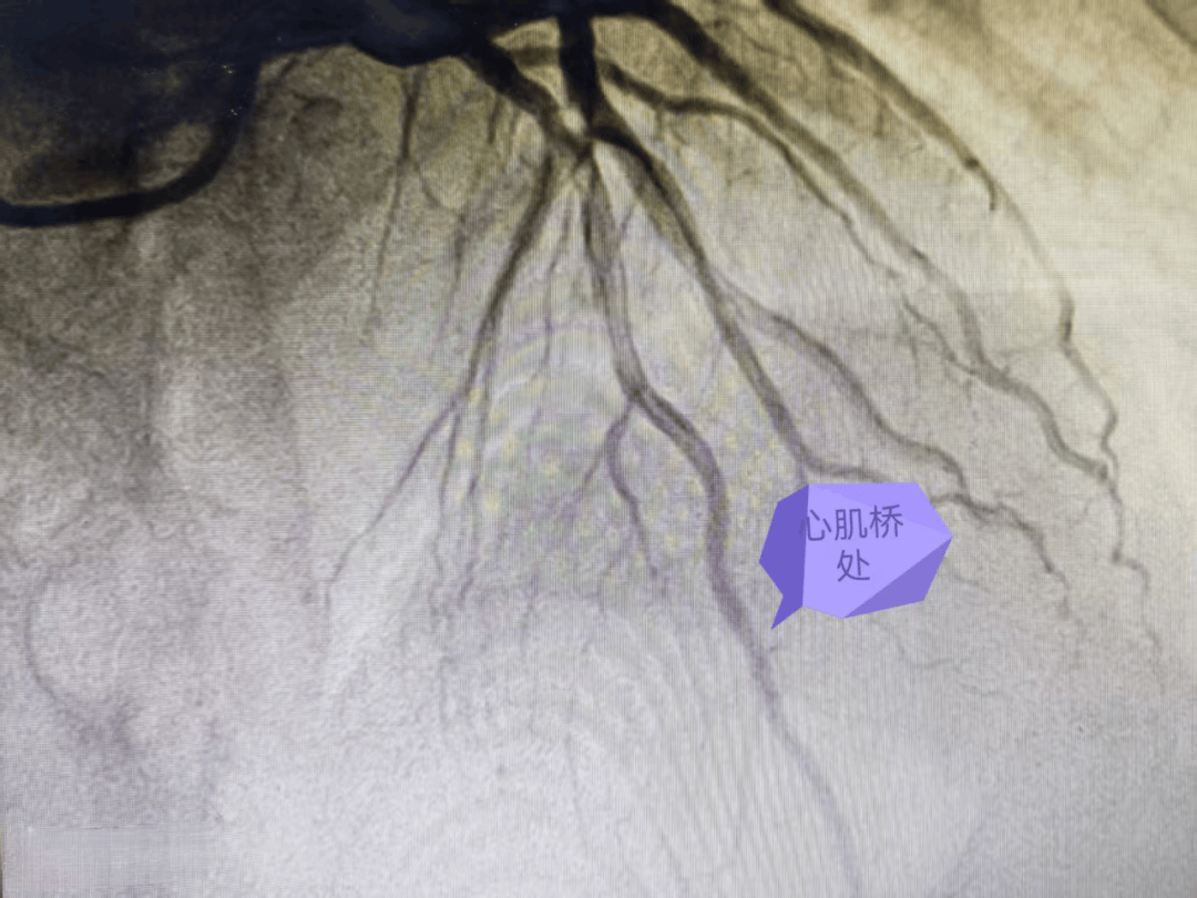 心肌桥特点是:心脏收缩时心肌内的冠状动脉受压