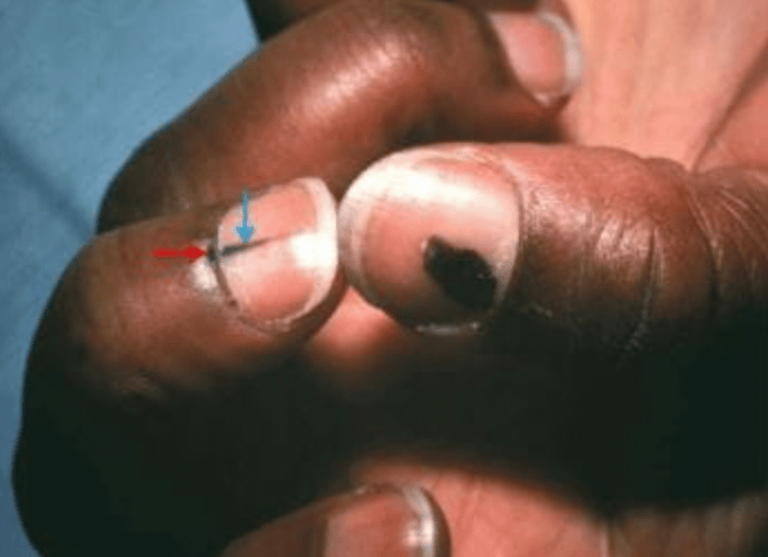 指甲出现这个变化,可能是癌变! 指甲出现这个变化,可能是癌变!