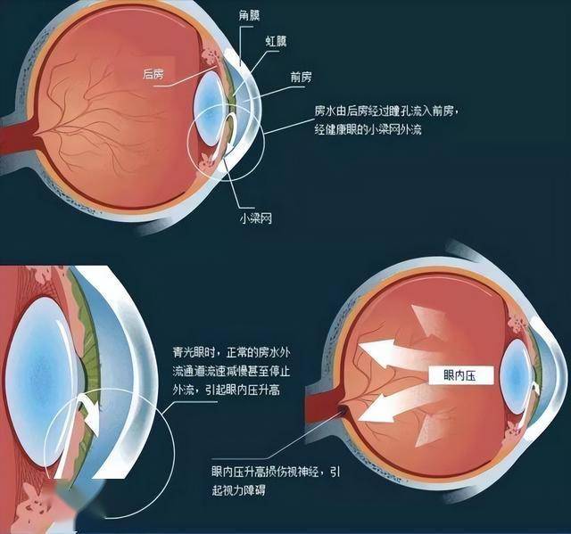 寒冬头痛呕吐？警惕急性青光眼突袭