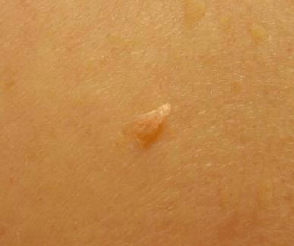 当妈后,乳晕上长出的小疙瘩是什么？需要担心么？