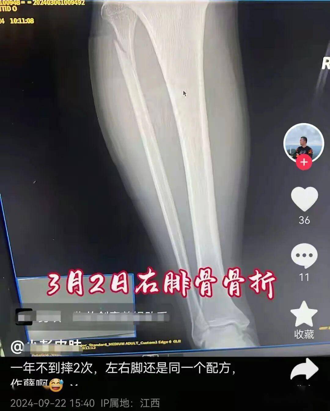 年9月还发视频自嘲一年摔两次左右脚都是同一个配方刚摔断右腓骨
