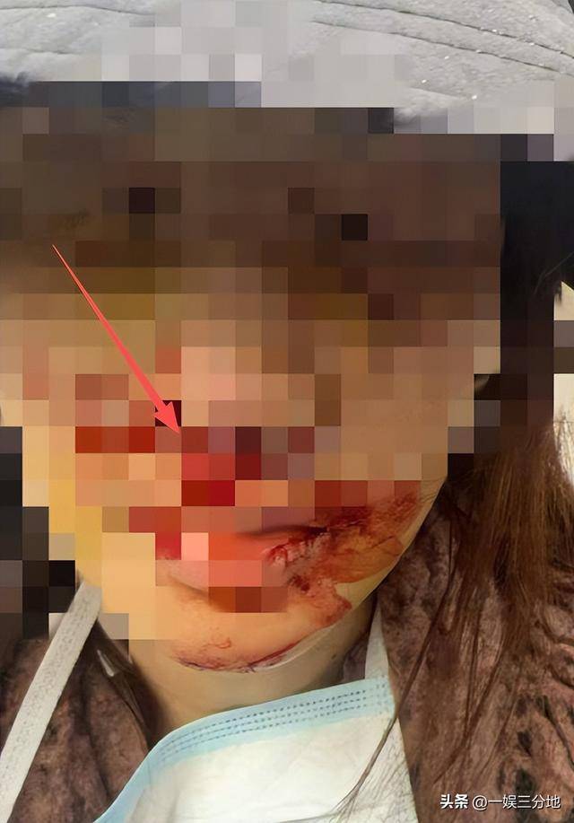 金晨晒满脸血迹的照片道歉,逃逸事件真相大白,却坐实另一个丑闻