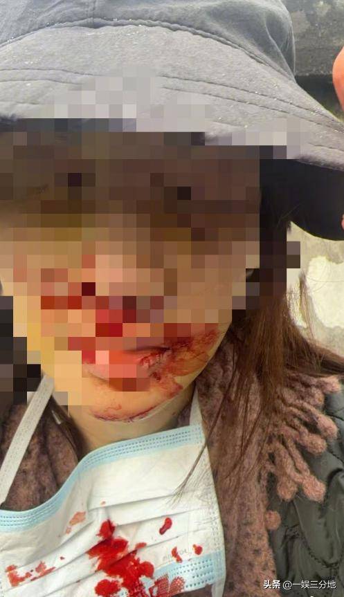 金晨晒满脸血迹的照片道歉,逃逸事件真相大白,却坐实另一个丑闻