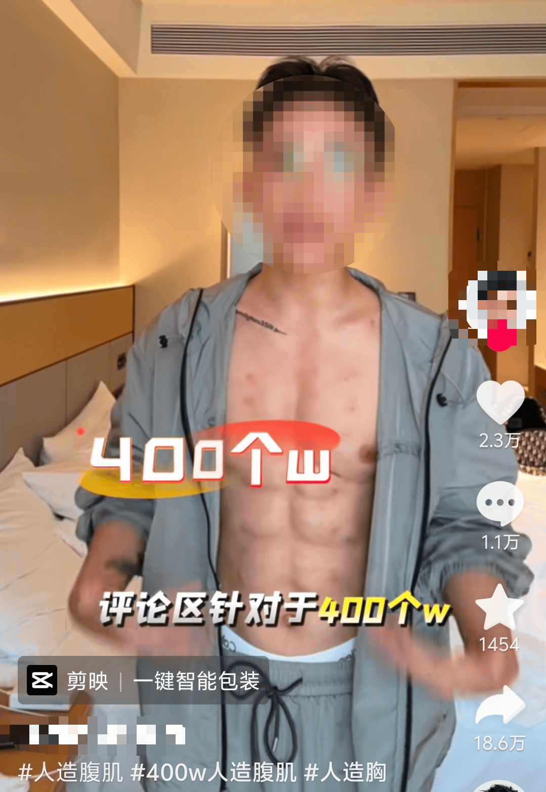 “有人花7万元打了83支玻尿酸”，多家医美机构可“造腹肌”，医生：有栓塞风险