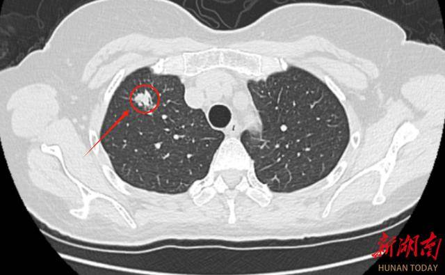 不吸烟也会得肺癌？女性这些防控要点别忽视！