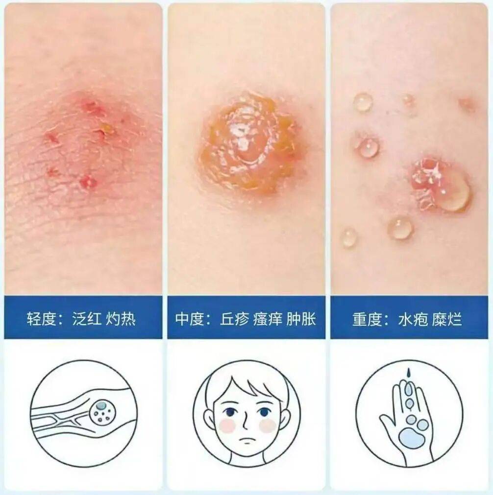 贤医健康说 | 别被“温柔春光”坑了!警惕春季高发的日光性皮炎_皮肤_皮损_防护