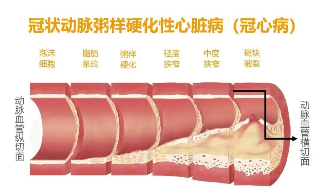 胸痛胸闷别忽视 老年人的“心脏第一杀手”——冠心病_冠状动脉_患者_发病率