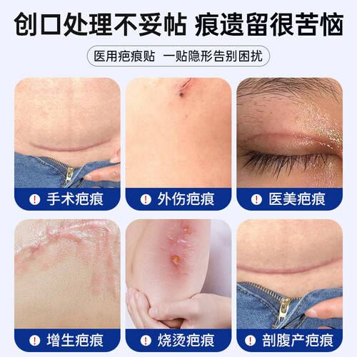 医用DR怎么使用DR.SANCAR医用祛疤痕贴使用体验：比传统方法好在哪？_https://www.jmylbn.com_新闻资讯_第1张