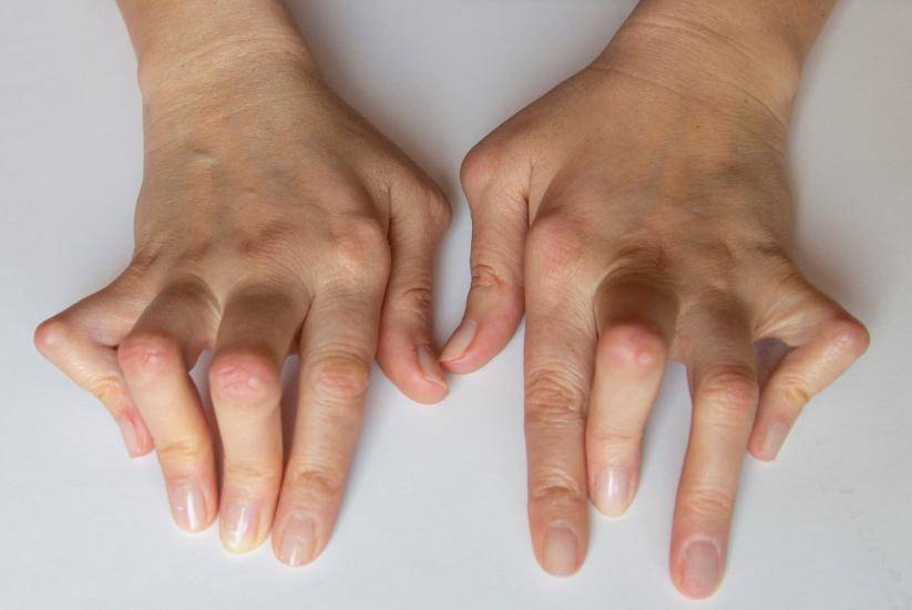 原创            从手指也能看出癌症？提醒：手指出现4个异常，赶紧排查病因！