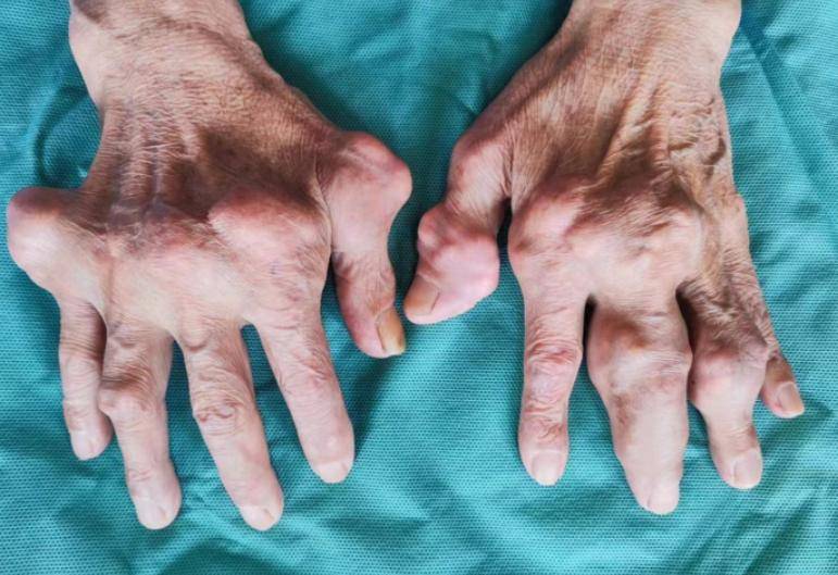 原创            嘌呤之王被揪出！医生再三苦劝：不想痛风，少吃这 5 种食物！