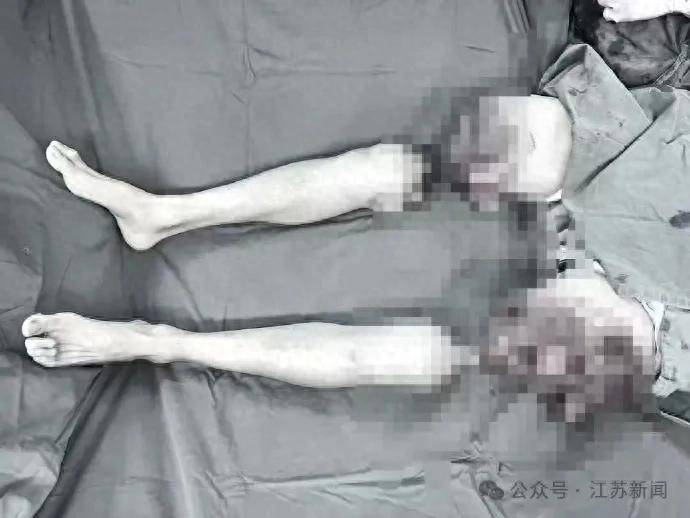 男子双大腿被压断，完全离体3小时，竟被接回去了！网友：医术精湛