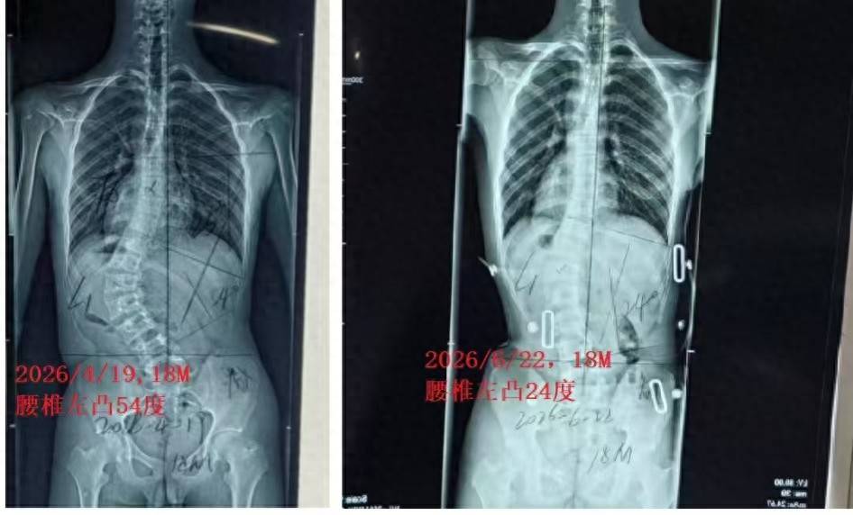 成人脊柱侧弯不能矫正？错！临床证实科学干预可有效改善